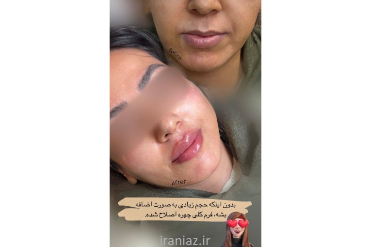 لیزر فیلر بوتاکس هایفو