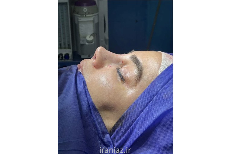 جراحی زیبایی بینی
