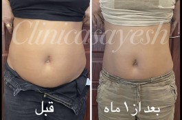 لاغری با کرایولیپولیز