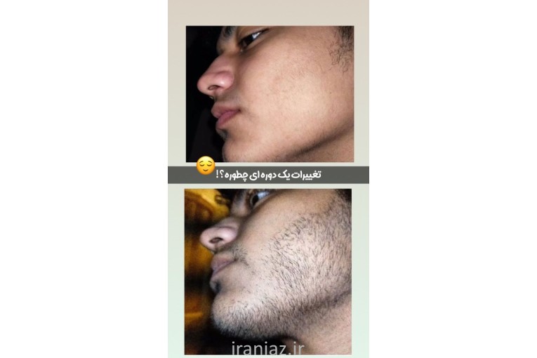رویش مجدد ریش و مو 