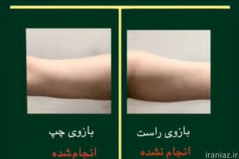 لاغری موضعی با ضمانت بازگشت وجه/آنالیز رایگان 