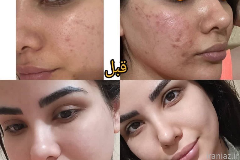 جوانسازی با متد بیوممتیک