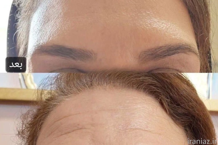 کرم جوانساز (جایگزین جراحی)