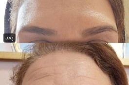 کرم جوانساز (جایگزین جراحی)