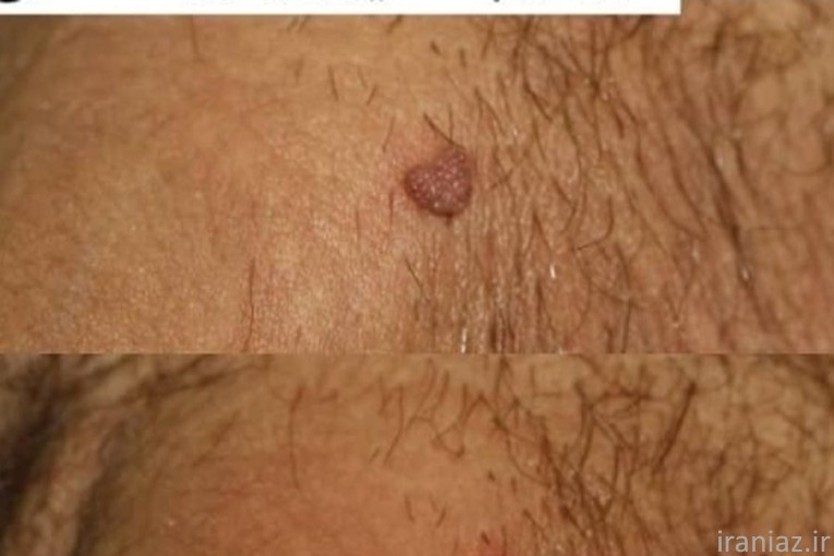 درمان زگیل تناسلی hpv میخچه ریمو تتو و ...