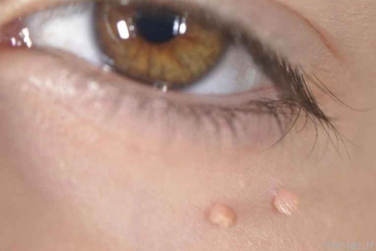 درمان زگیل تناسلی hpv میخچه ریمو تتو و ...