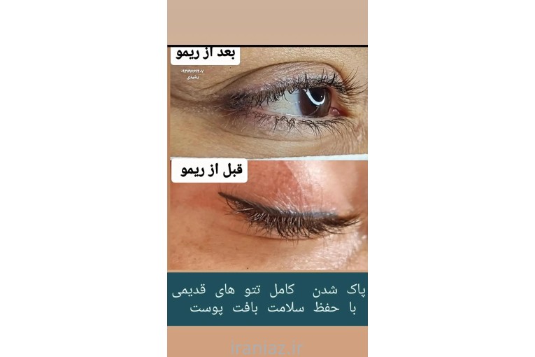 فیبروز و ریمو تخصصی تتوی صورت