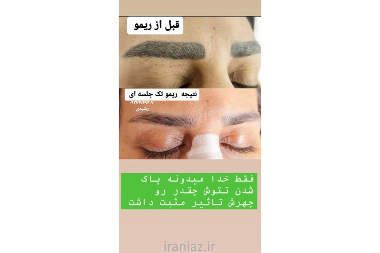 فیبروز و ریمو تخصصی تتوی صورت
