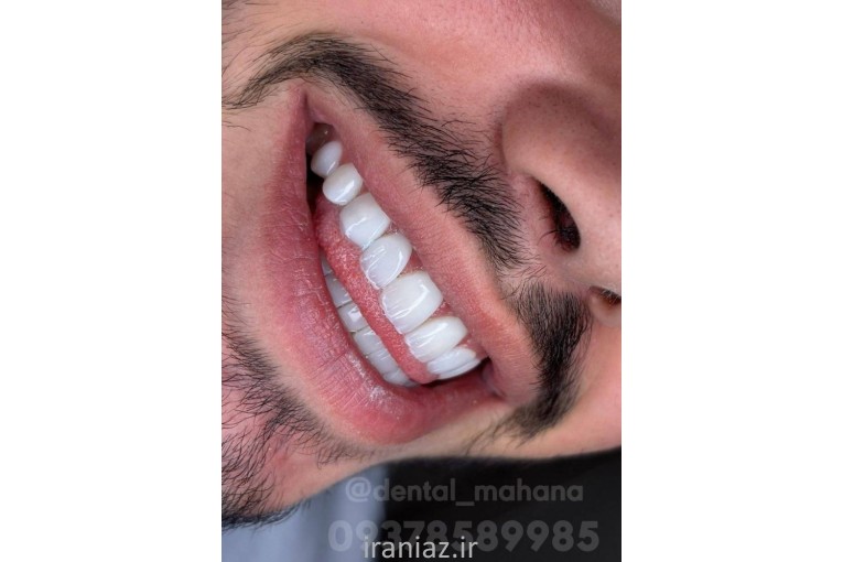 دندانپزشکی کرج کامپوزیت دندان، لمینت، ایمپلنت