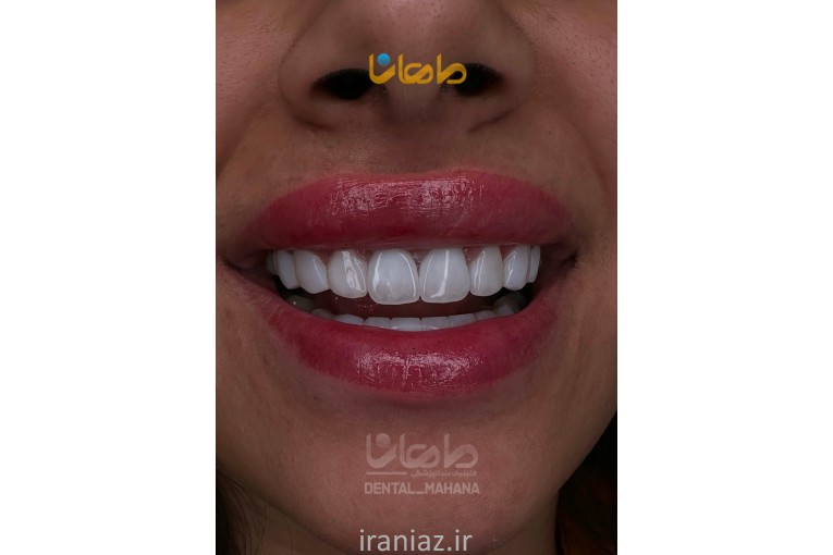 دندانپزشکی کرج کامپوزیت دندان، لمینت، ایمپلنت