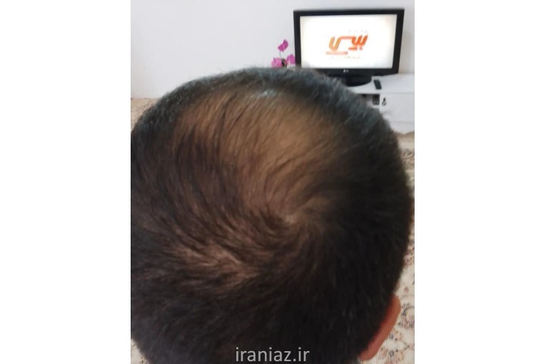 محلول ضد ریزش مو و رویش مجدد موها