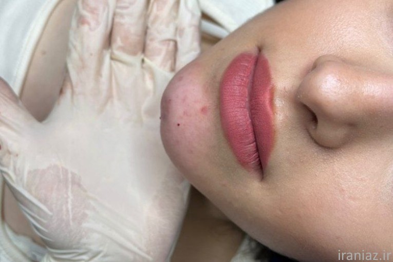خدمات زیبایی تزریق ژل و بوتاکس