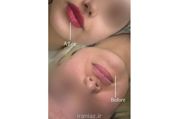 خدمات زیبایی تزریق ژل و بوتاکس