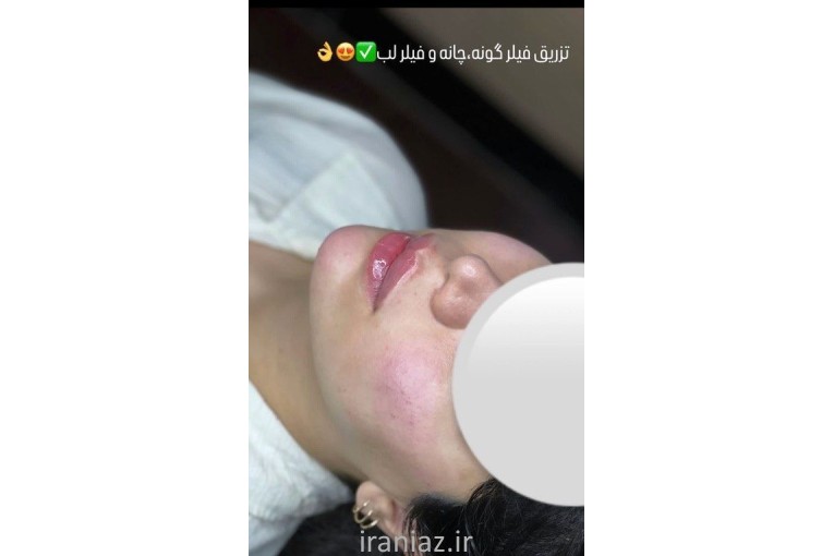 خدمات زیبایی تزریق ژل و بوتاکس