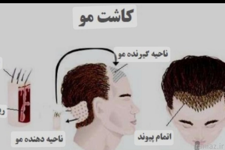 کاشت مو حرفه ای پرتراکم
