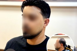 بهترین درمان ریزش مو،کم پشتی و طاسی
