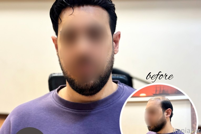 بهترین درمان ریزش مو،کم پشتی و طاسی