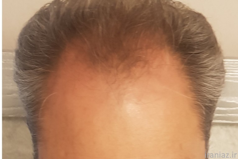 کاشت مو و ابرو اصفهان