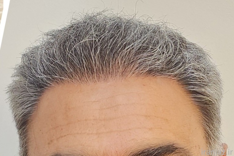کاشت مو و ابرو اصفهان