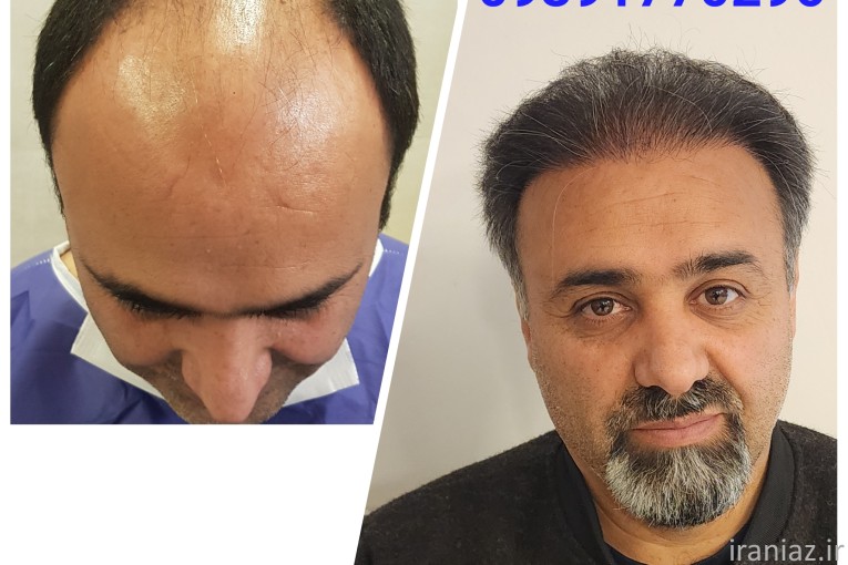 کاشت مو و ابرو اصفهان