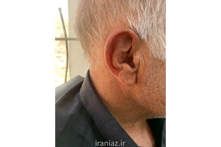 سمعک پارس - بهترین مرکز خرید سمعک در چهارراه طالقانی کرج