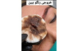 ریمو تتو صورت