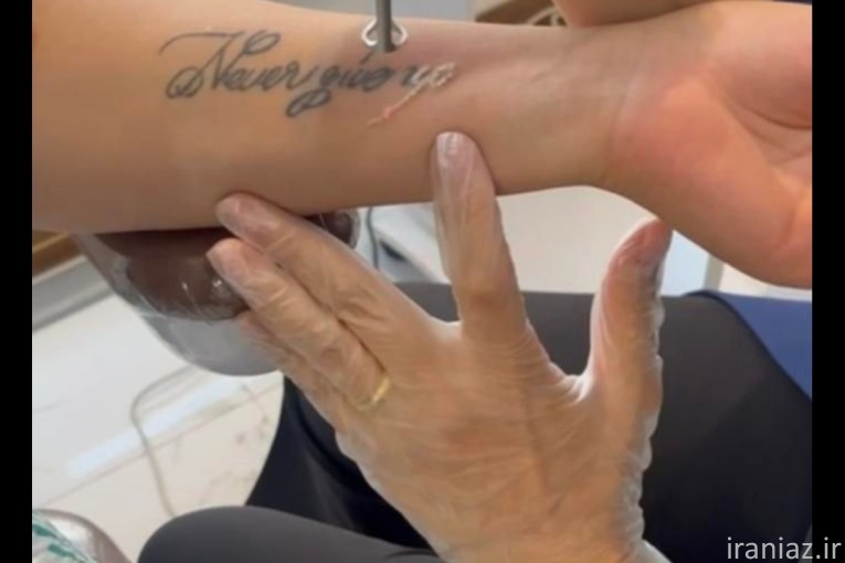 پاک کردن تتو بدن و صورت با لیزر