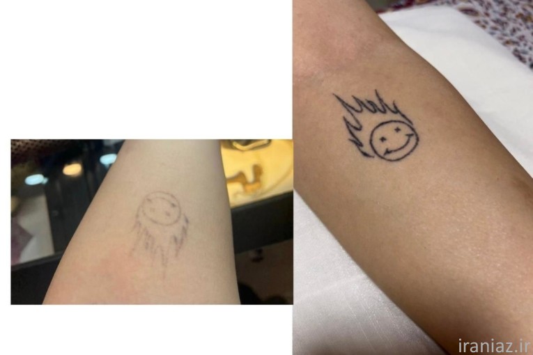 پاک کردن تتو بدن و صورت با لیزر