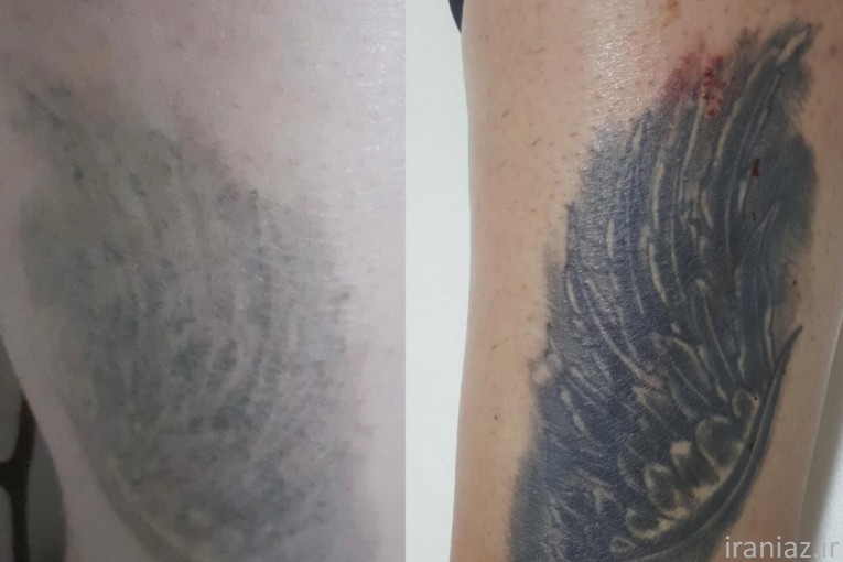 پاک کردن تتو بدن و صورت با لیزر
