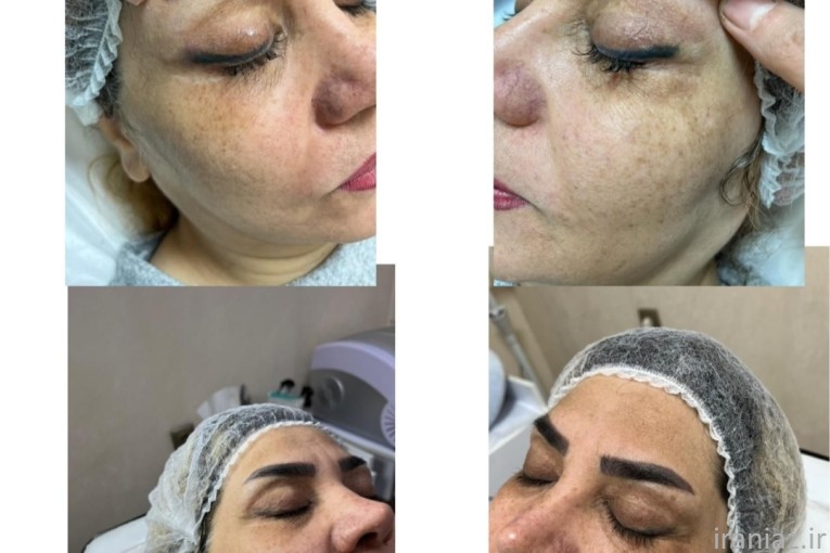 پاک کردن تتو بدن و صورت با لیزر