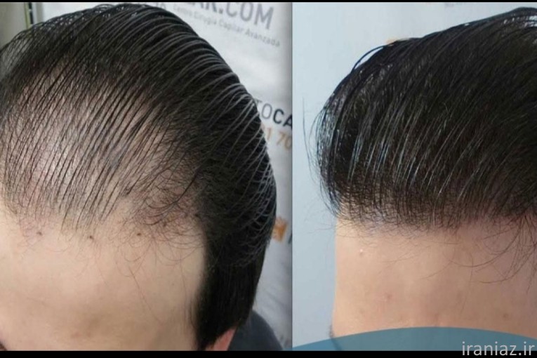 جشنواره کاشت مو در نسیم شهر 