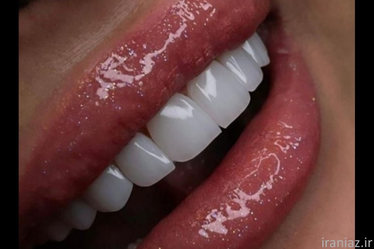 دندانپزشکی/کامپوزیت/لمینت/روکش دندان