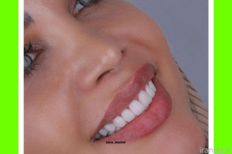 بیلچینگ لمینت کامپوزیت دندانپزشکی