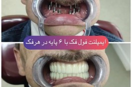 ایمپلنت کره ای با روکش