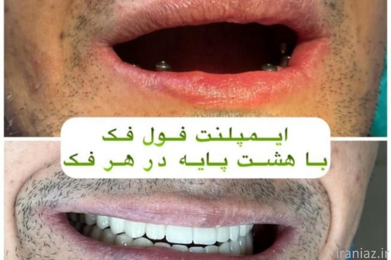 ایمپلنت کره ای با روکش