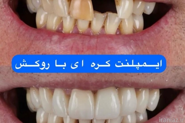 ایمپلنت کره ای با روکش