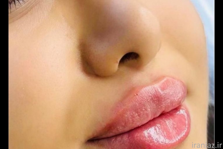 ژل بوتاکس آنزیم بینی 