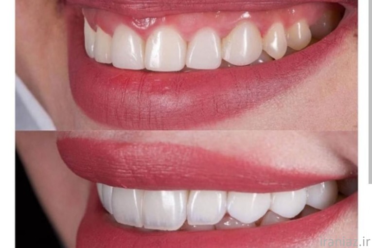 جشنواره دندانپزشکی و کامپوزیت و لمینت ایمپلنت