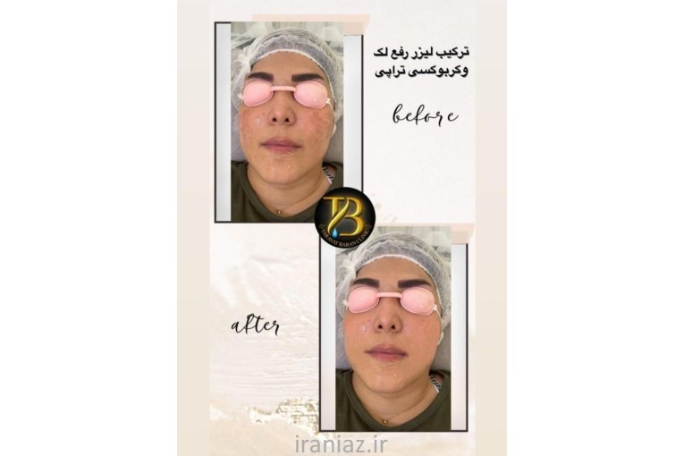 هایفو ۱۲ بعدی گلد بوتاکس و ...