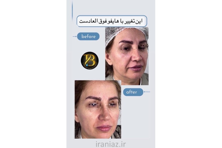 هایفو ۱۲ بعدی گلد بوتاکس و ...