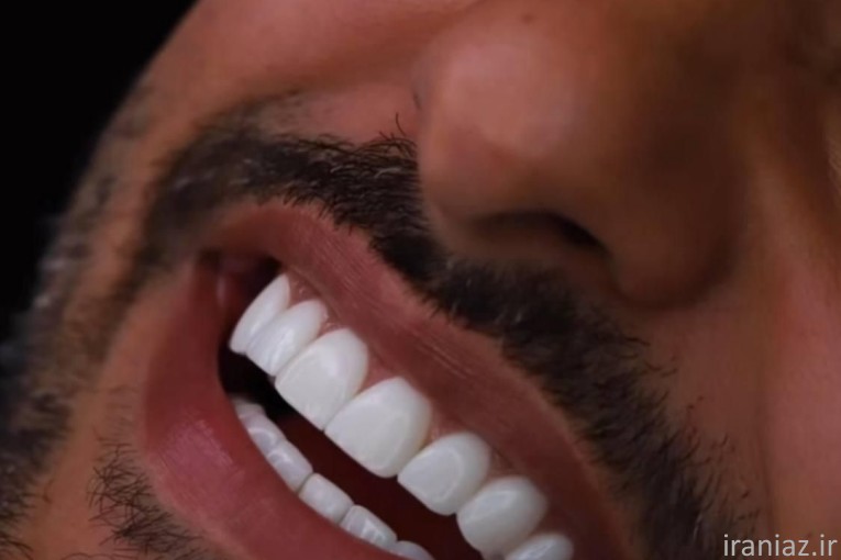 ایمپلنت و کامپوزیت