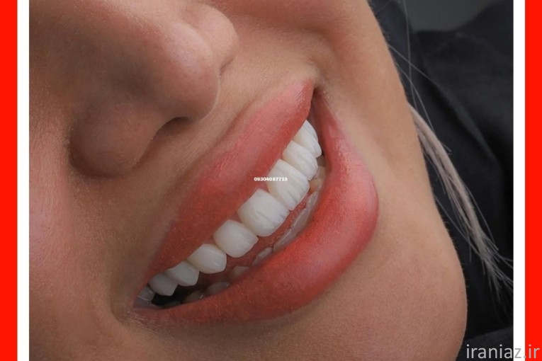 جشنواره دندان کامپوزیت روکش