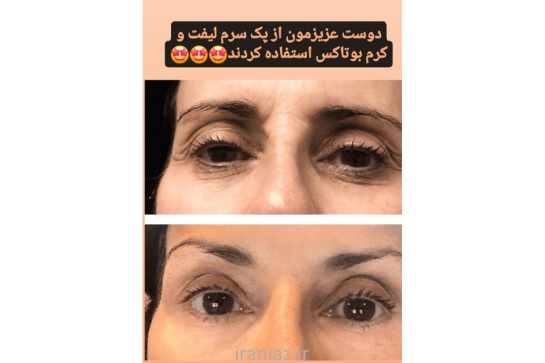 کرم بوتاکس گاتیو اصل ایتالیایی