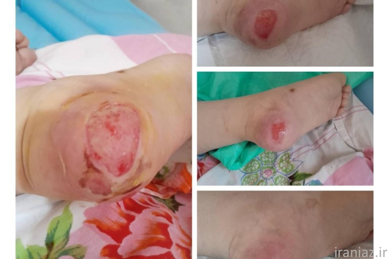 درمان تخصصی انواع زخم توسط پزشک عمومی مجرب 